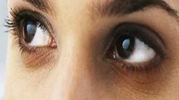 مثلث خلاص شدن از تیرگی های دور چشم 