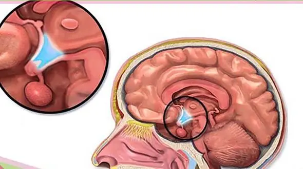 تومور هیپوفیز چیست؟ / راه های تشخیص و درمان 