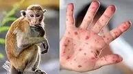 شناسایی آبله میمون در یک کشور همسایه ایران / بیمار اخیرا سابقه سفر نداشته است