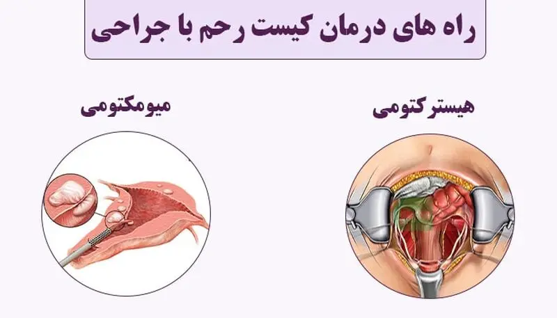 درمان کیست رحم با جراحی