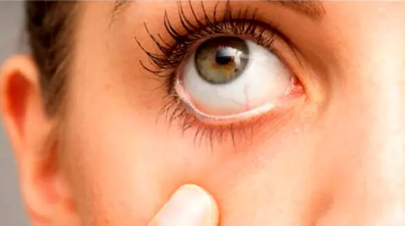 چگونه علائم بیماری کلیوی را در چشم‌ ها تشخیص دهیم؟