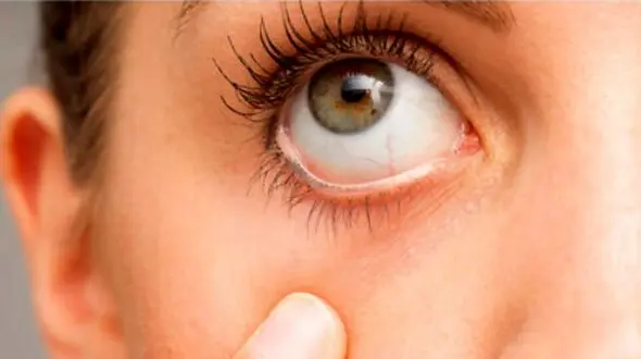چگونه علائم بیماری کلیوی را در چشم‌ ها تشخیص دهیم؟
