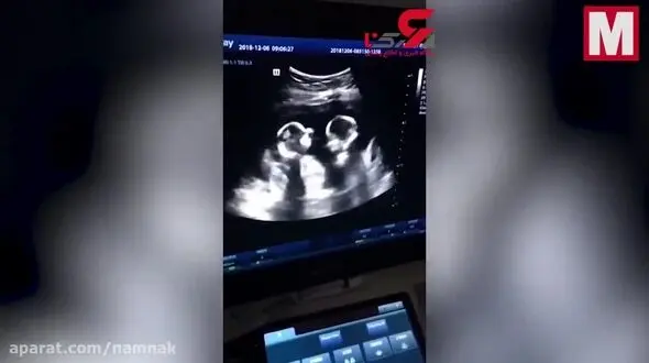 فیلم لحظه دعوای بامزه دوقلوها در رحم مادر چینی ! 