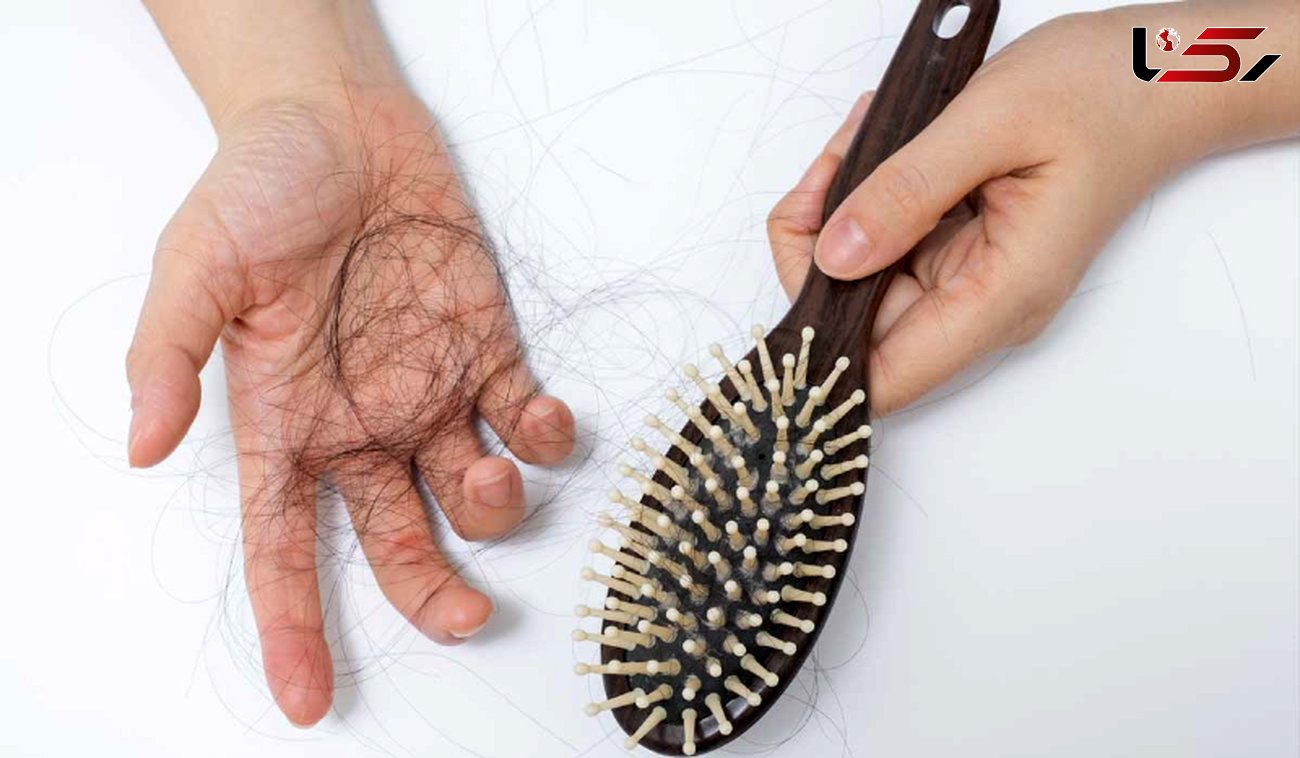 چرا ریزش مو در زنان بیشتر است؟