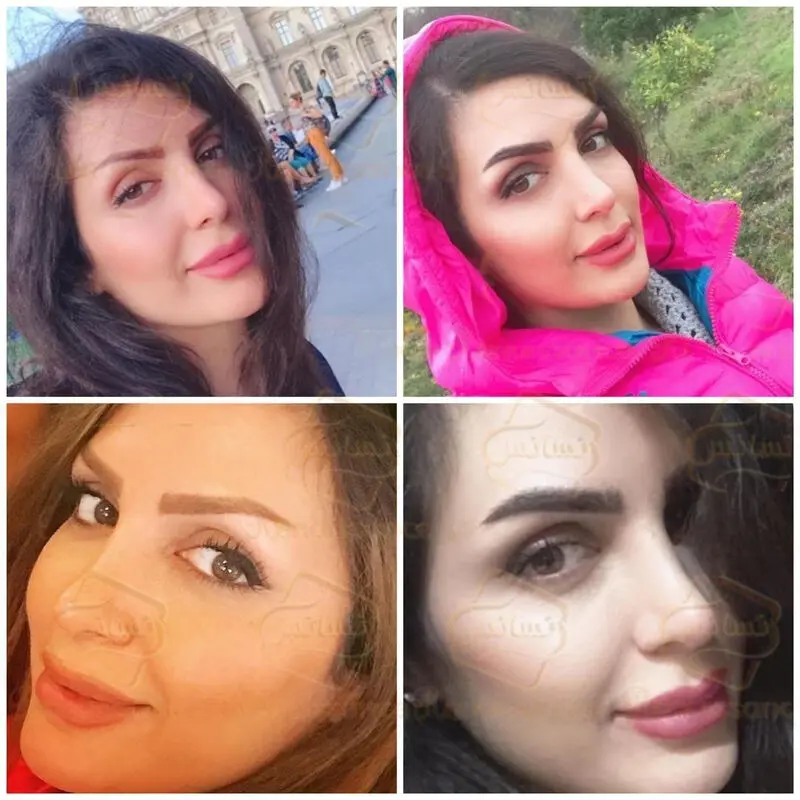 بهترین روش کاشت مو – تکنیک سوپر کاشت کلینیک رنسانس