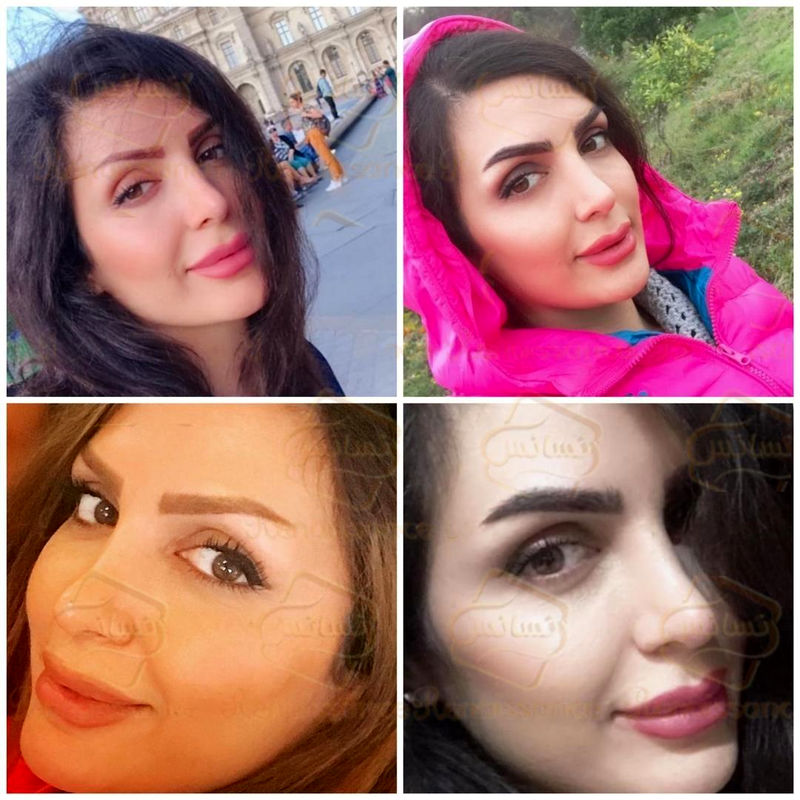 بهترین روش کاشت مو – تکنیک سوپر کاشت کلینیک رنسانس