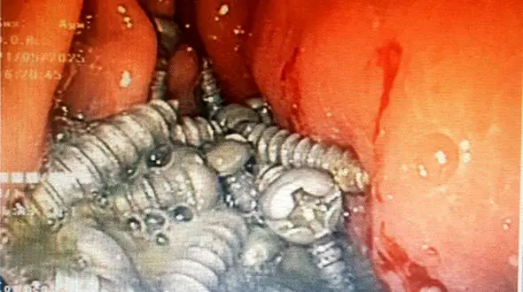 خارج کردن 47 پیچ فلزی از معده یک بیمار در کرج!