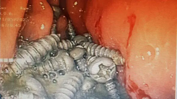 خارج کردن 47 پیچ فلزی از معده یک بیمار در کرج!