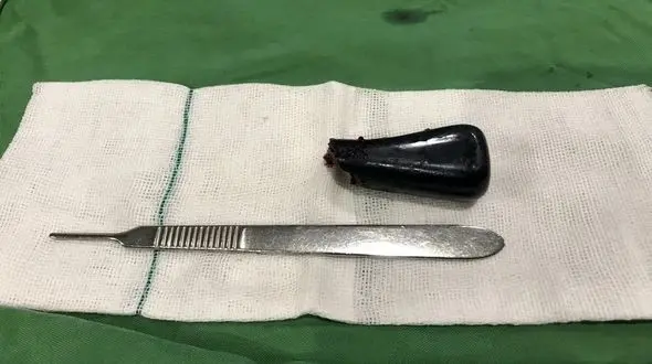 بیرون کشیدن دسته دنده خودروی آریا از گلوی پیرمرد گیلانی بعد از 40 سال! / جراحی سخت در رشت + فیلم