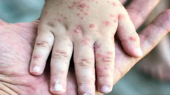 طالبان؛ عامل شیوع سرخک در یران! / تزریق واکسن از مرگ ناشی از سرخک جلوگیری می کند + فیلم 