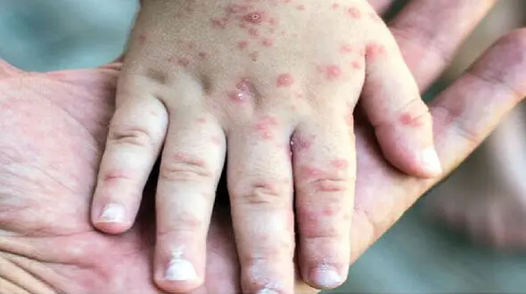سرخک دوباره برگشت! / سازمان جهانی بهداشت هشدار داد