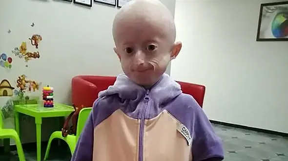 این دختر در عرض 10 سال چنان پیر شد که از دنیا رفت ! + عکس / اوکراین