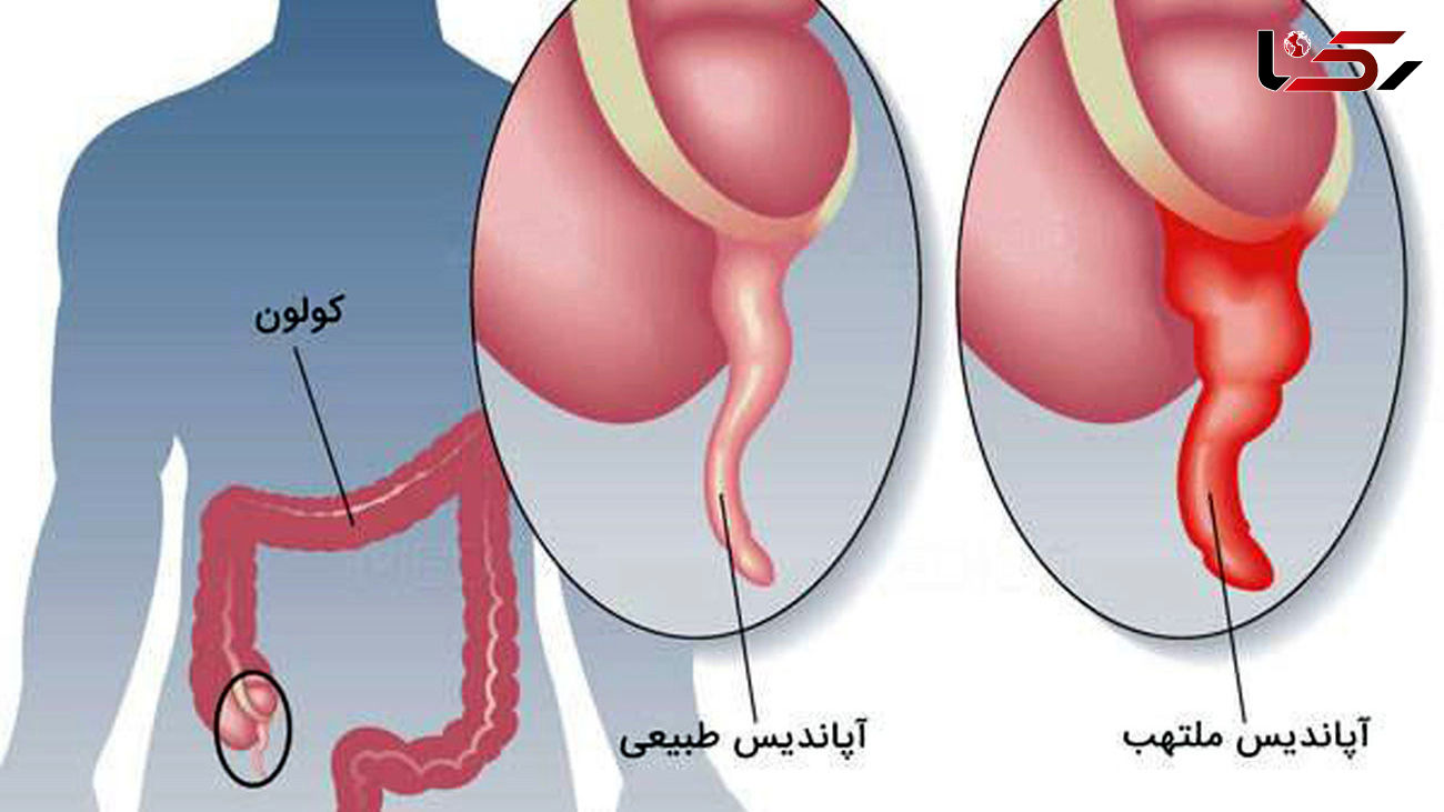 آپاندیس و آپاندیسیت را بیشتر بشناسیم