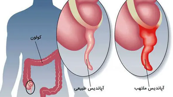 آپاندیس و آپاندیسیت را بیشتر بشناسیم