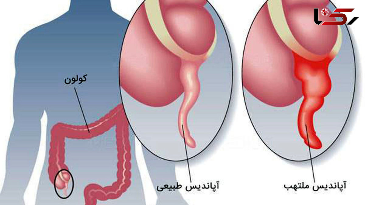 آپاندیس و آپاندیسیت را بیشتر بشناسیم