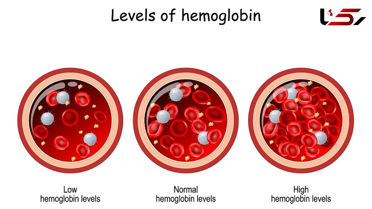 راهکارهای پیشگیری از افزایش هموگلوبین خون / لخته شدن خون را جدی بگیرید