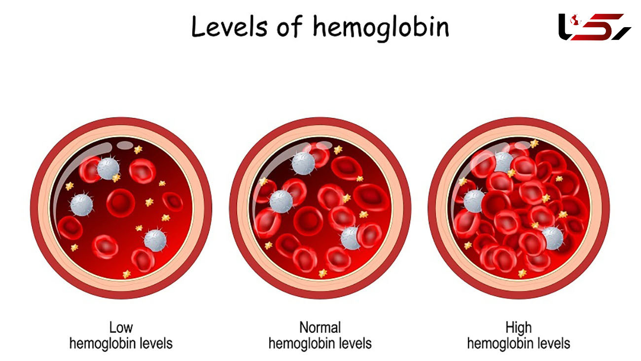 راهکارهای پیشگیری از افزایش هموگلوبین خون / لخته شدن خون را جدی بگیرید