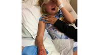 سوختگی شدید دختر 6 ساله توسط تتوی حنا+تصاویر