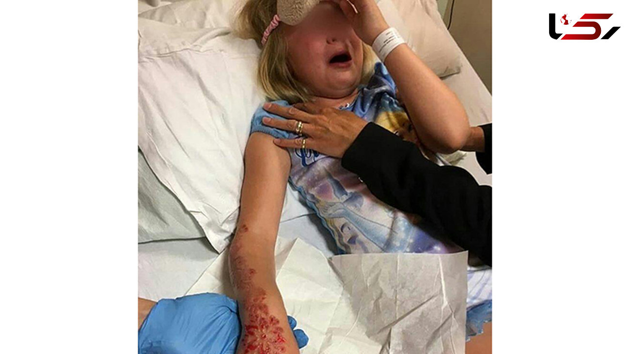 سوختگی شدید دختر 6 ساله توسط تتوی حنا+تصاویر