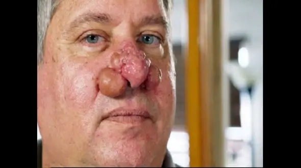 عکسی وحشتناک از توده‌های بزرگ روی بینی مرد آمریکایی!