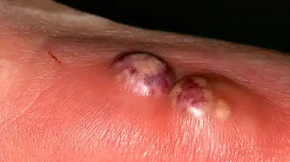 کورک چیست؟ / انواع درمان کورک + 6 جدول مهم 