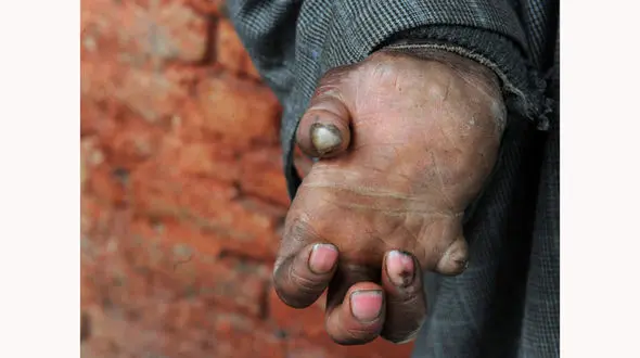 طاعون خیارکی چیست و آیا در ایران شیوع پیدا کرده است؟! + عکس