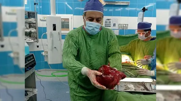 بیرون آوردن توده 3 و نیم کیلویی از کلیه یک بیمار در تربت‌حیدریه / همه شوکه شدند + عکس