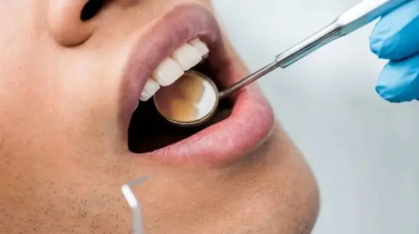 پوسیدگی دندان؛ چگونه می‌ تواند به 5 بیماری خطرناک منجر شود؟