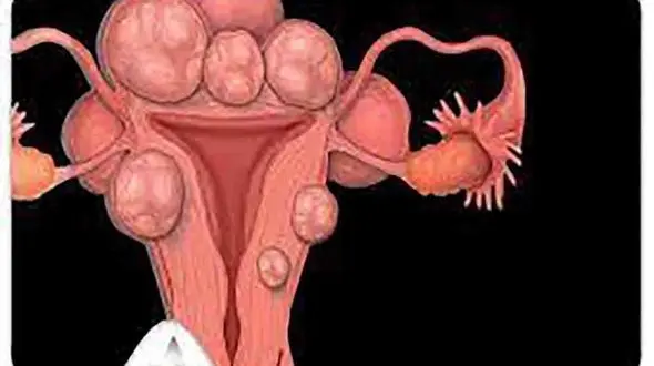 قابل توجه خانم ها / ظلم به رحم چیست؟