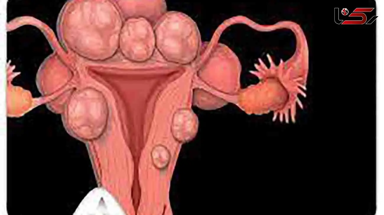 قابل توجه خانم ها / ظلم به رحم چیست؟