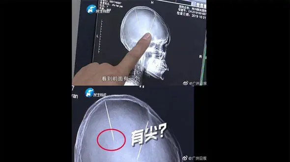 راز وحشتناک دو سوزن داخل سر زن جوان + عکس