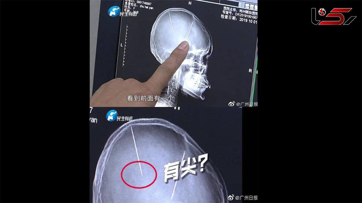 راز وحشتناک دو سوزن داخل سر زن جوان + عکس
