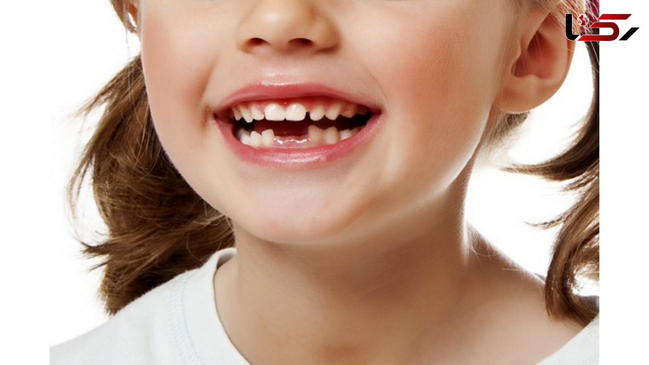 شیر یا بزاق دهان بهترین محیط برای نگهداری دندان افتاده در اثر ضربه است 