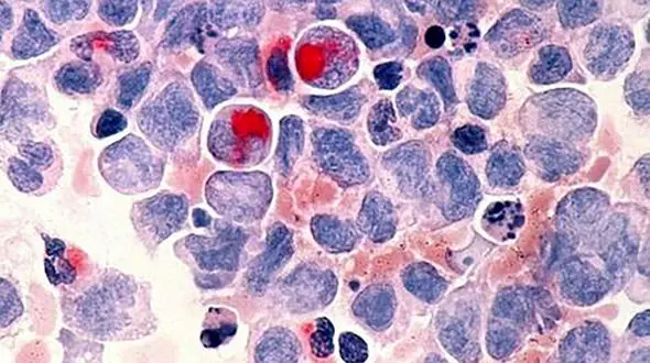 هوش مصنوعی به شناسایی سرطان پروستات پرداخت