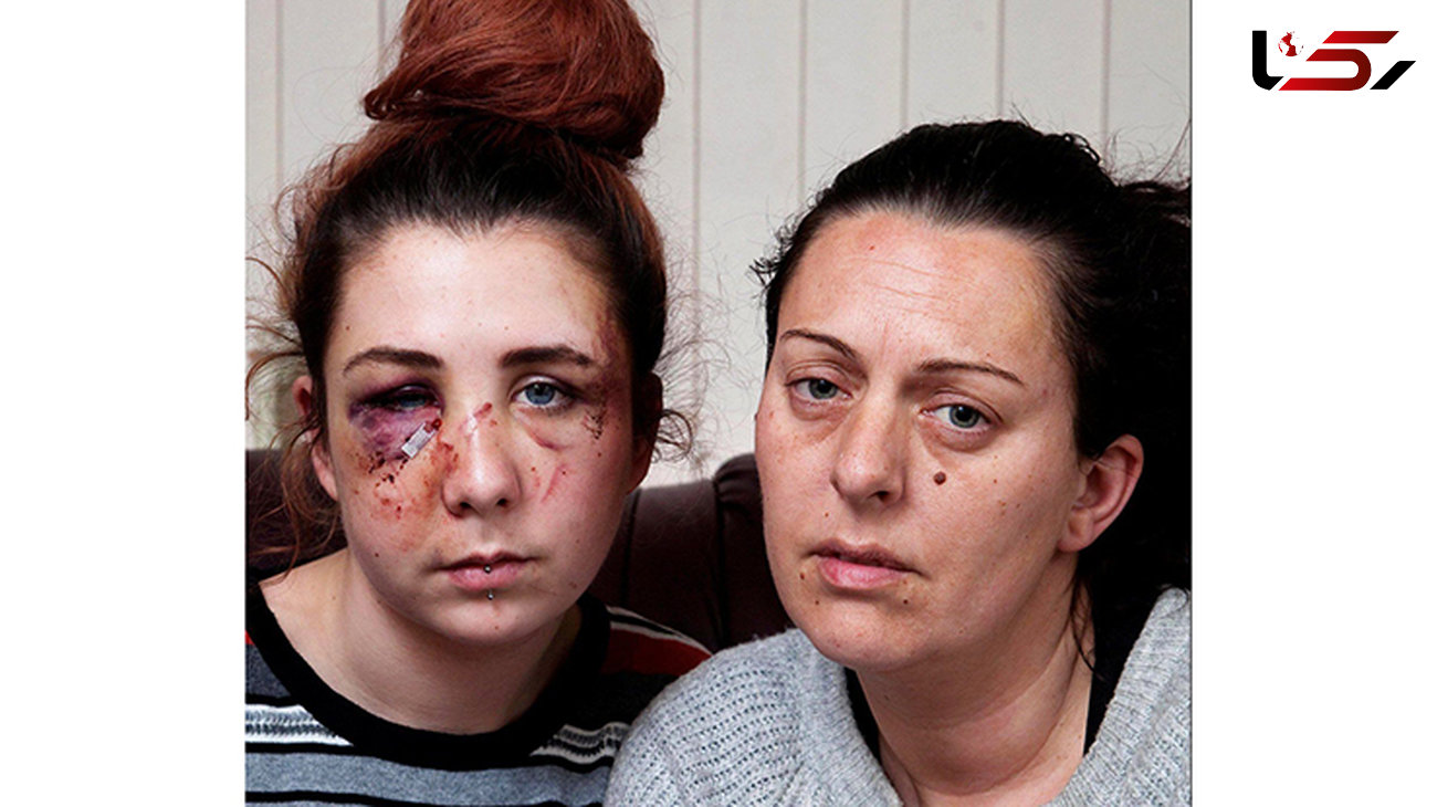 حمله وحشیانه به یک دختر پولدار در خیابان / چهره این دختر متلاشی شد+ تصاویر(+16) 