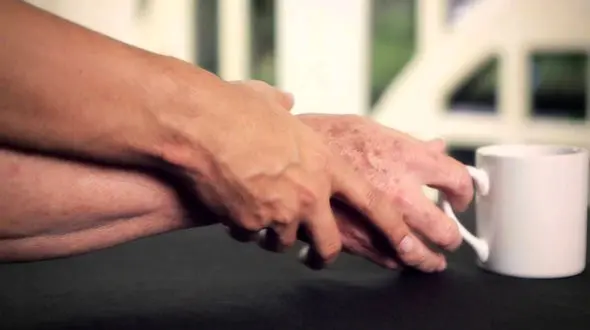 همه آنچه که باید درباره بیماری پارکینسون بدانید