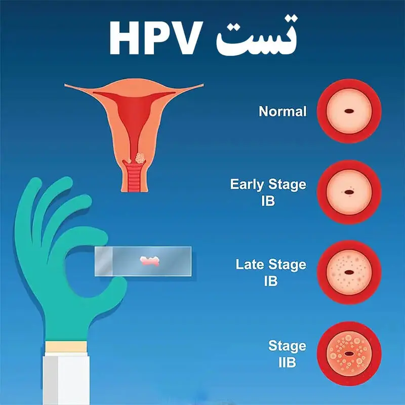 تست hpv در زنان