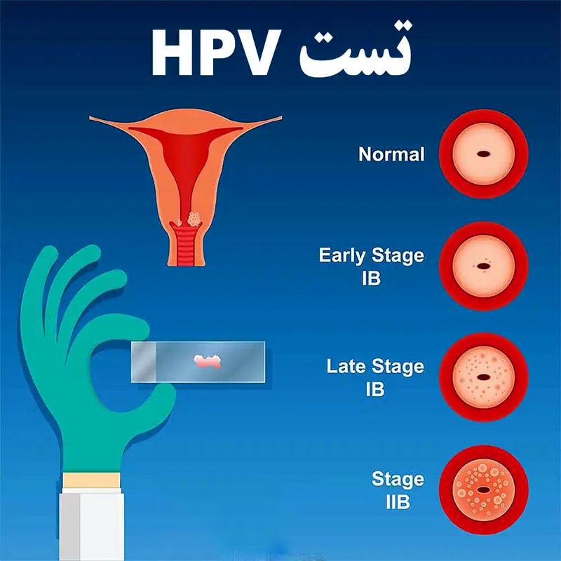 تست hpv در زنان