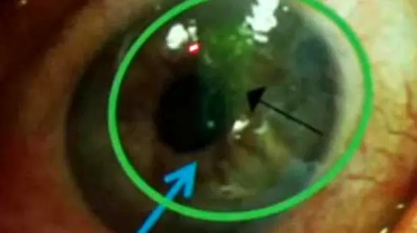 زندگی کردن 4 زنبور عسل در چشمان زن جوان +عکس