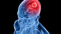 نشانه های تومور مغزی چیست؟