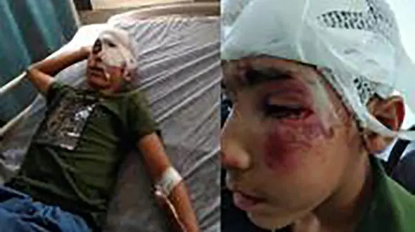 مانی هاشمی کولبر 14 ساله تحت عمل جراحی چشم قرار گرفت / در تهران صورت گرفت+ عکس