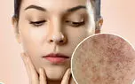 ماکولار چیست؟ / بررسی جدول های ماکولار پوستی + فیلم 