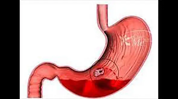 نشانه های رایج خونریزی دستگاه گوارش