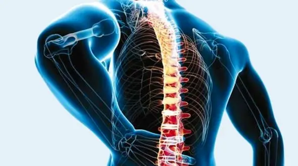 سکته نخاعی چیست؟