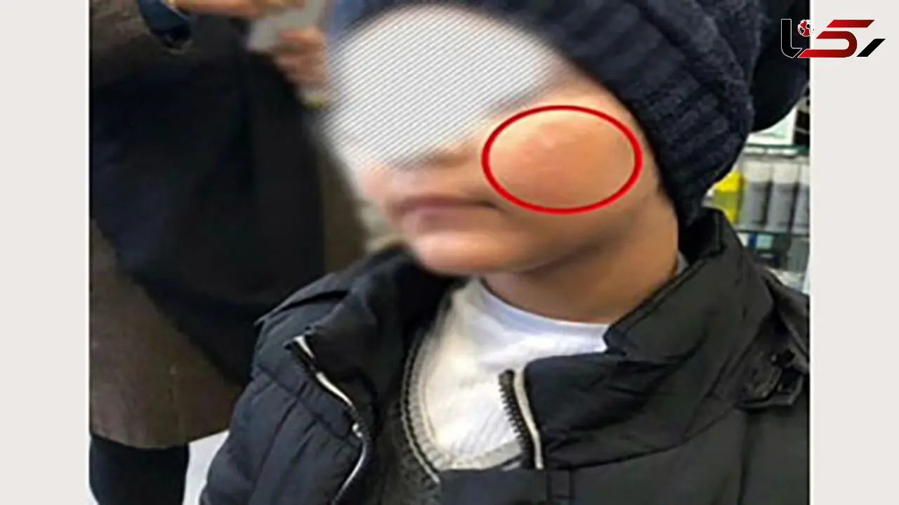 ماجرای سوزاندن صورت یک پسر بچه با کفگیر در مهد کودک رامسر؟+ عکس