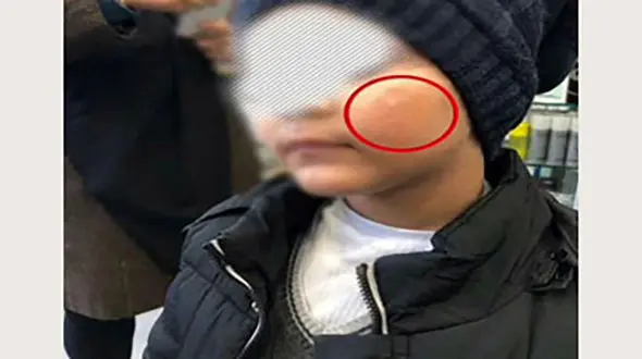 ماجرای سوزاندن صورت یک پسر بچه با کفگیر در مهد کودک رامسر؟+ عکس