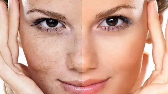 تغییرات رنگ پوست خبر از چه بیماری هایی می دهند؟