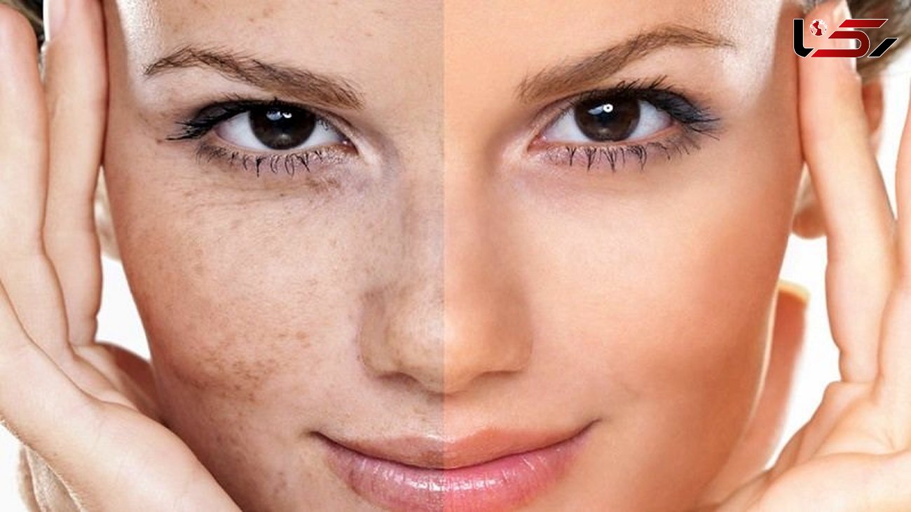 تغییرات رنگ پوست خبر از چه بیماری هایی می دهند؟