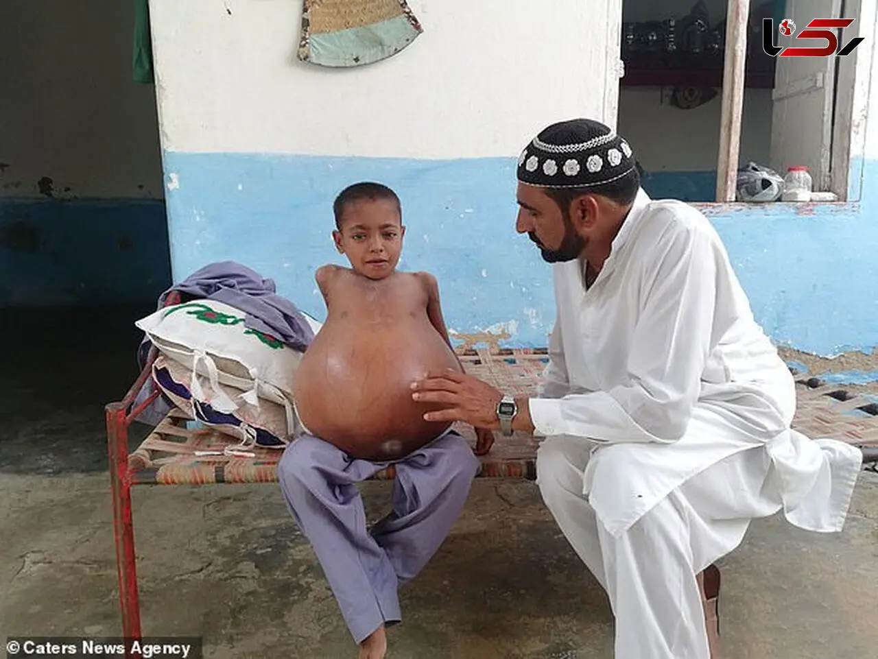  شکم برآمده پسر ۹ ساله خبرساز شد +تصاویر باورنکردنی