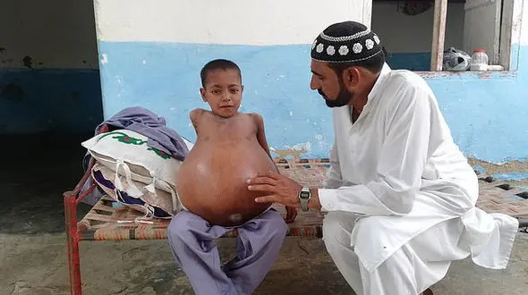  شکم برآمده پسر ۹ ساله خبرساز شد +تصاویر باورنکردنی